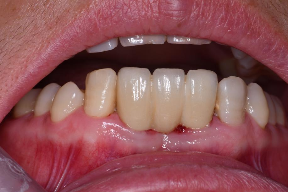 after restoration with zirconia crown bridge on custom dental abutments