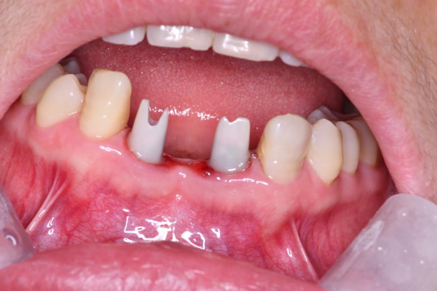 before restoration with Megagen implants and zirconia custom abutments