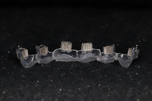Indirect Bonding Tray