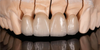 All-Ceramic &Zirconia Crowns