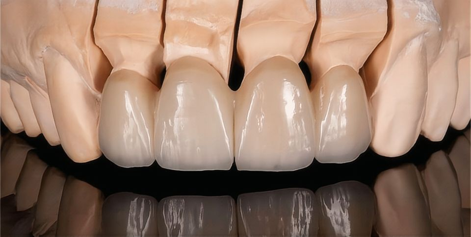 All-Ceramic &Zirconia Crowns