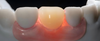 Flexible Partial Denture
