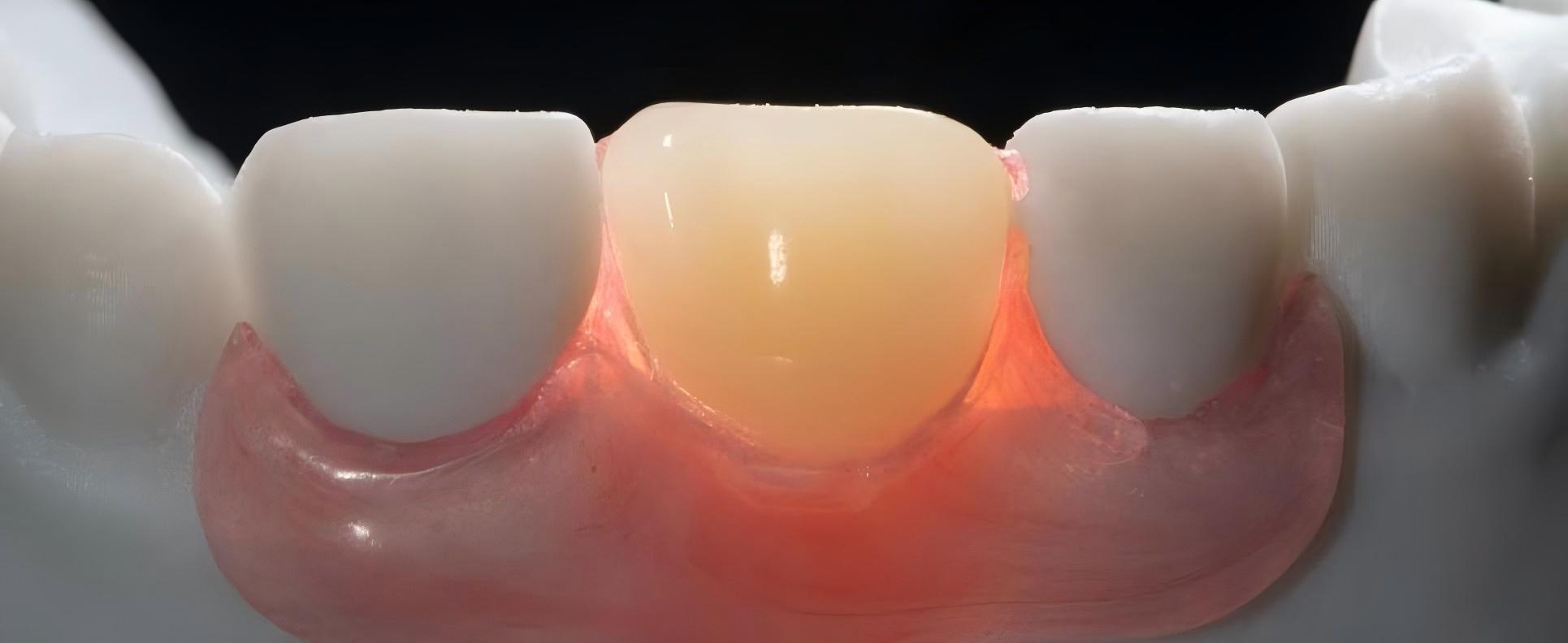 Flexible Partial Denture