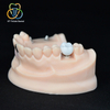 Implant-Supported Full-Contour Multilayer Zirconia Crown