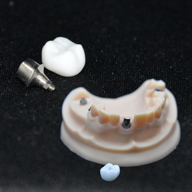 Implant-Supported Full-Contour Multilayer Zirconia Crown