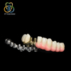 Implant-Supported Malo Bridge with Individual Ceramic Crowns