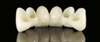 All-Ceramic &Zirconia Crowns