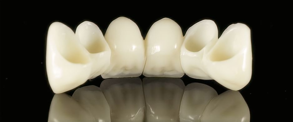 All-Ceramic &Zirconia Crowns