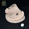 Implant-Supported Full-Contour Multilayer Zirconia Crown
