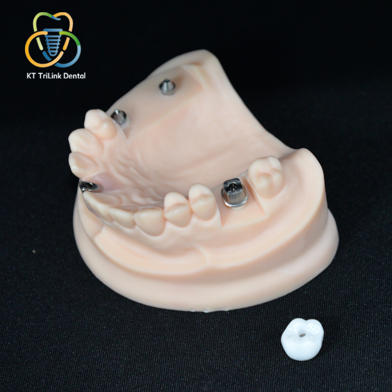 Implant-Supported Full-Contour Multilayer Zirconia Crown