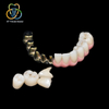 Implant-Supported Malo Bridge with Individual Ceramic Crowns