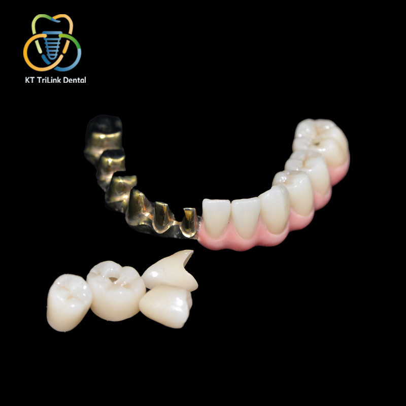 Implant-Supported Malo Bridge with Individual Ceramic Crowns