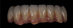All-Ceramic &Zirconia Crowns