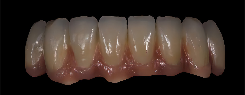 All-Ceramic &Zirconia Crowns