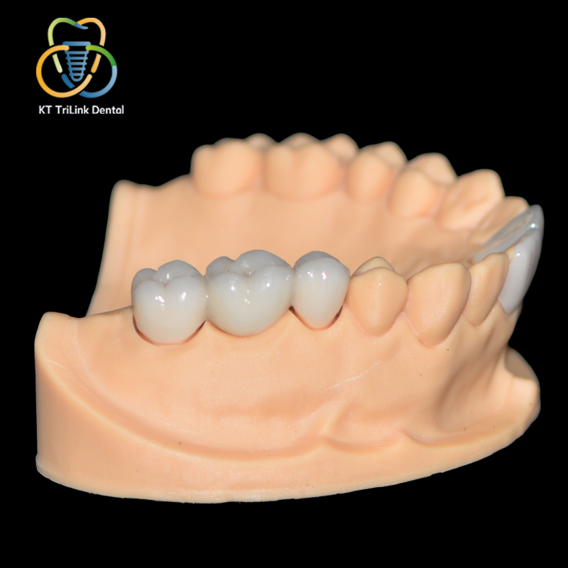 Zirconia All‑ceramic Crown