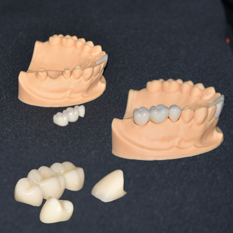 Zirconia All‑ceramic Crown