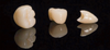 All-Ceramic &Zirconia Crowns